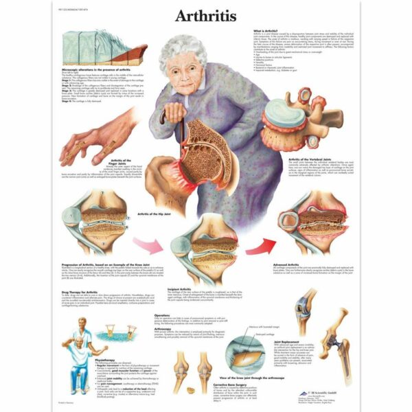Poster Arthritis gelamineerd