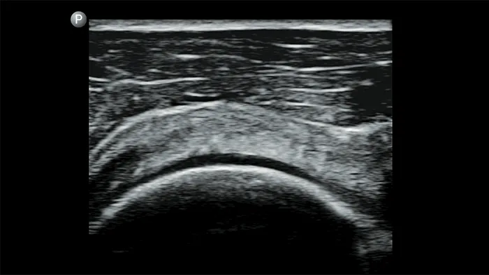 philips lumify beeld schouder